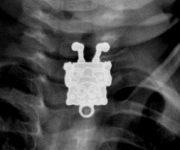 İnsanların kaza ile yuttuğu tuhaf şeyler