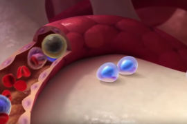 Sık rastlanan bir kemik iliği hastalığı: Multipl miyelom