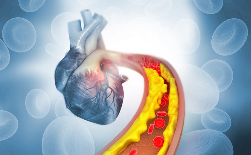 Kalp krizine neden olan plakları azaltan bir nanoparçacık geliştirildi