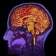 Migren beyni nasıl değiştiriyor?