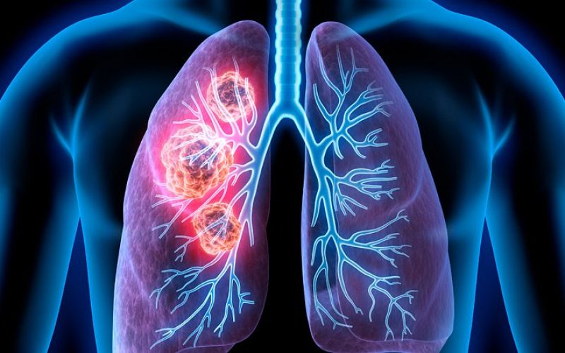 Akciğer kanserine yönelik yeni bir ilaç