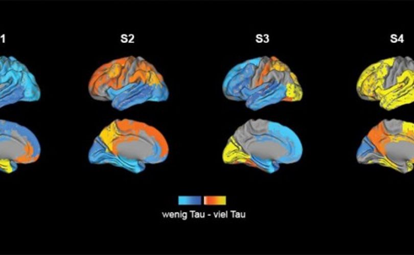 Alzheimer’in dört alt tipi tespit edildi