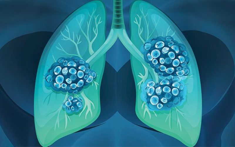 Sigara içmeyenlerdeki akciğer kanserinin sorumlusu üç mutasyonmuş