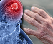 Parkinson hastalığı hakkında kısa bilgiler