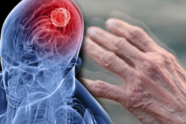 Parkinson hastalığı hakkında kısa bilgiler