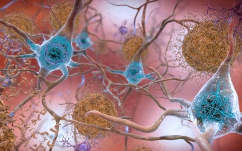 Alzheimer: Yeni bulgular daha iyi tedavinin yolunu açacak