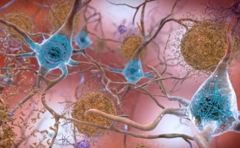 Alzheimer: Yeni bulgular daha iyi tedavinin yolunu açacak