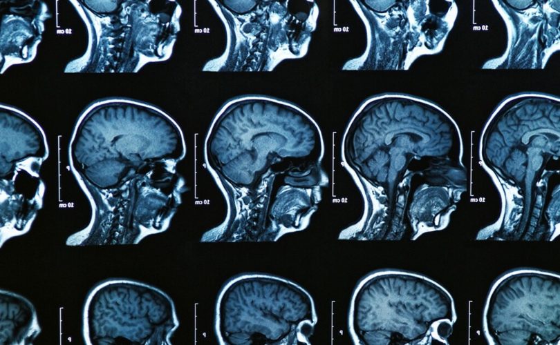 100.000 beyin görüntüsüyle beynin gelişimi izlenebilecek