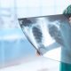 Yapay zeka tek röntgenle kalp krizini tahmin ediyor
